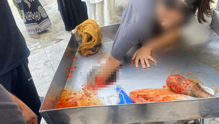 Şanlıurfa’da Salça Makinesine Kaptırdığı Elinden Genç Kız Mikrocerrahi Müdahale İle Kurtarıldı