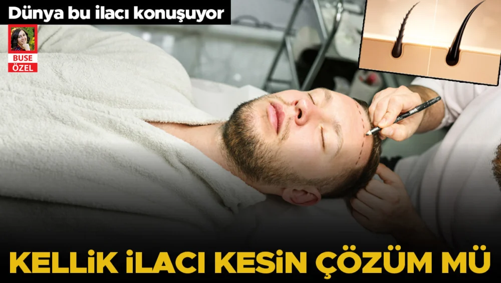 Erkek Tipi Kellik Tedavisinde Yeni İlaç Yüzde 539 Oranında İyileşme Sağladı